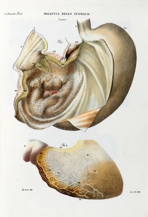  Cruveilhier Jean : Atlante generale della anatomia patologica del corpo umano [...] prima versione italiana del dottore Pietro Banchelli.  Pietro Banchelli  - Asta Libri & Grafica - Libreria Antiquaria Gonnelli - Casa d'Aste - Gonnelli Casa d'Aste