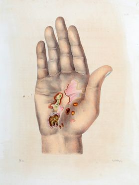  Ricord Philippe : Trattato completo delle malattie veneree. Clinica iconografica dell'ospedale dei venerei... Medicina  - Auction Graphics & Books - Libreria Antiquaria Gonnelli - Casa d'Aste - Gonnelli Casa d'Aste