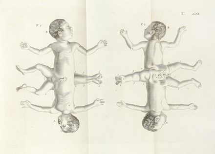  Mondini Francesco : [Opuscula... Bicorporei humani Monstri anatomica descriptio].  [..]